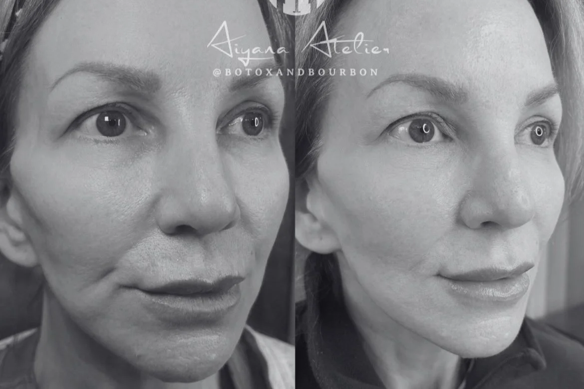 Sculptra: The Eternal Gift