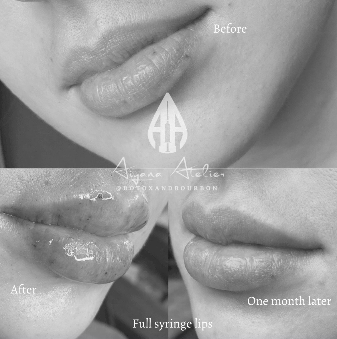 Comparison of lips before and after a lip augmentation procedure. The top image shows natural lips, while the bottom left shows lips after injection, appearing more full and plump. The bottom right shows lips one month after the procedure.