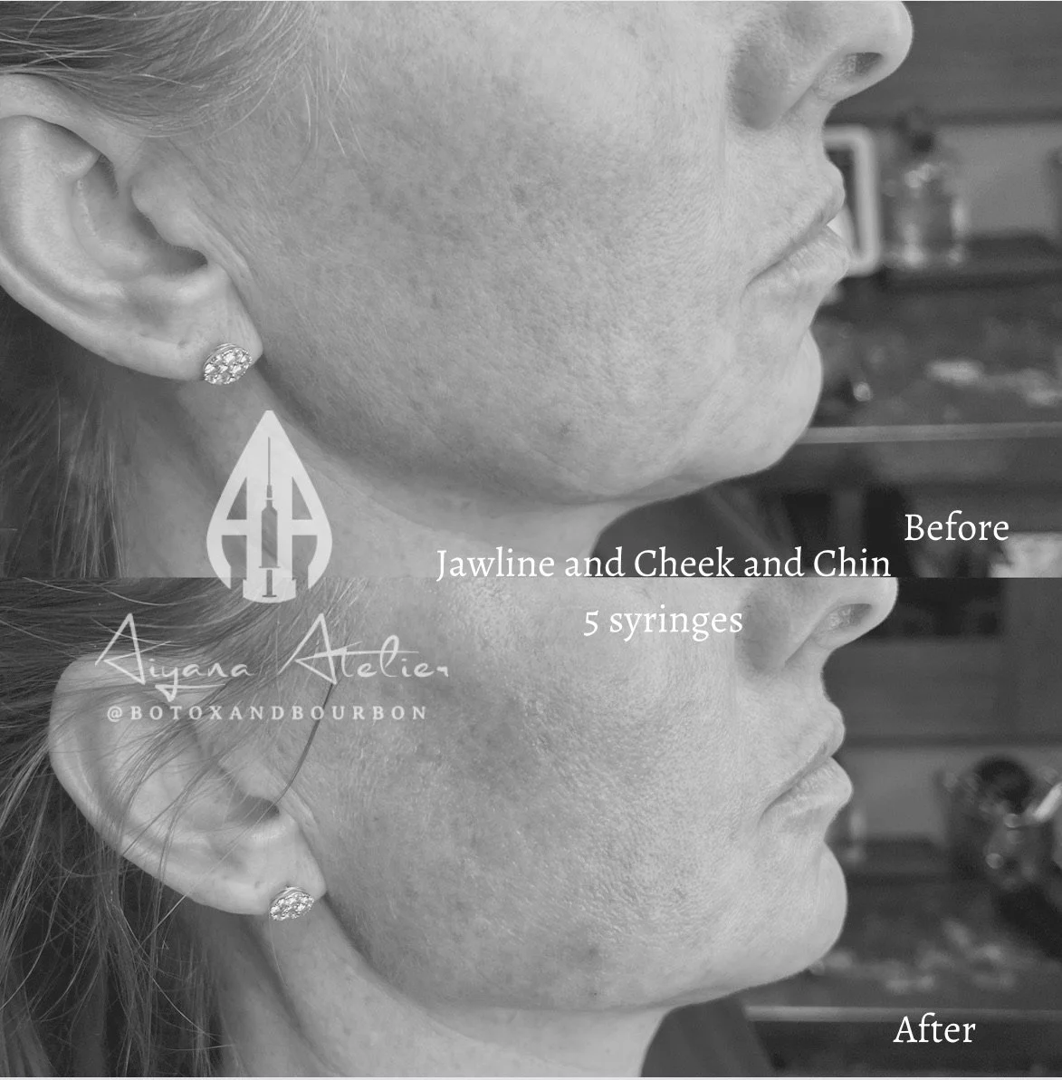 Black and white side-by-side comparison of a woman's lower face before and after Botox treatment. The top image shows the face with visible wrinkles, while the bottom image shows smoother skin after treatment. Text indicates the procedure involves 5 