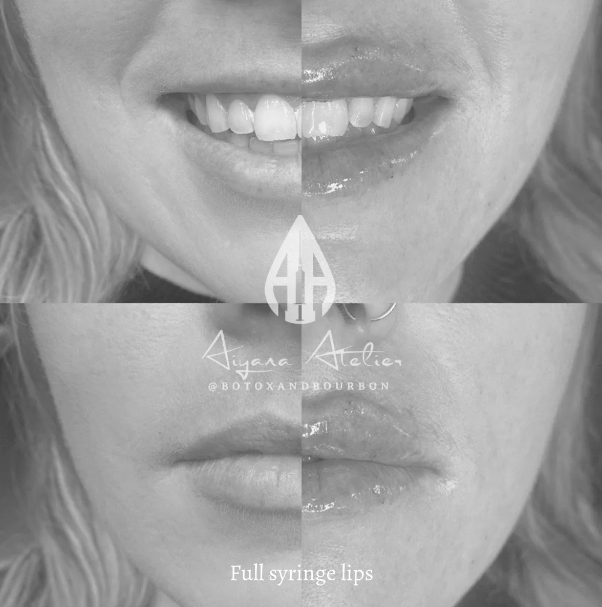 Black and white before-and-after photos showing a woman's lips, with the top showing natural lips and the bottom showing lips after full syringe lip enhancement, labeled 'Full syringe lips'.