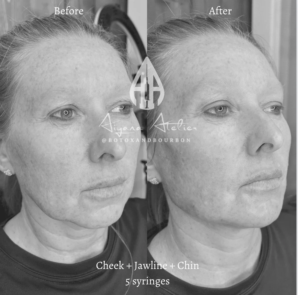Side-by-side black and white photos of an older woman showing before and after results of a facial procedure. The left photo is labeled 'Before' and shows the woman's face with visible skin imperfections. The right photo is labeled 'After' and shows 