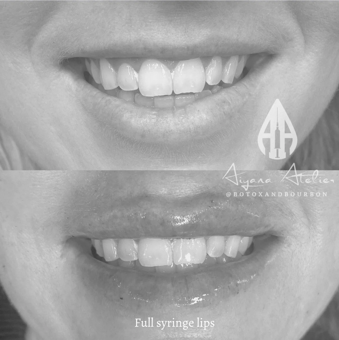 Close-up of smiling lips and teeth, showing full syringe lips after cosmetic procedure, with text 'Full syringe lips' and branding '@botoandbourbon'.