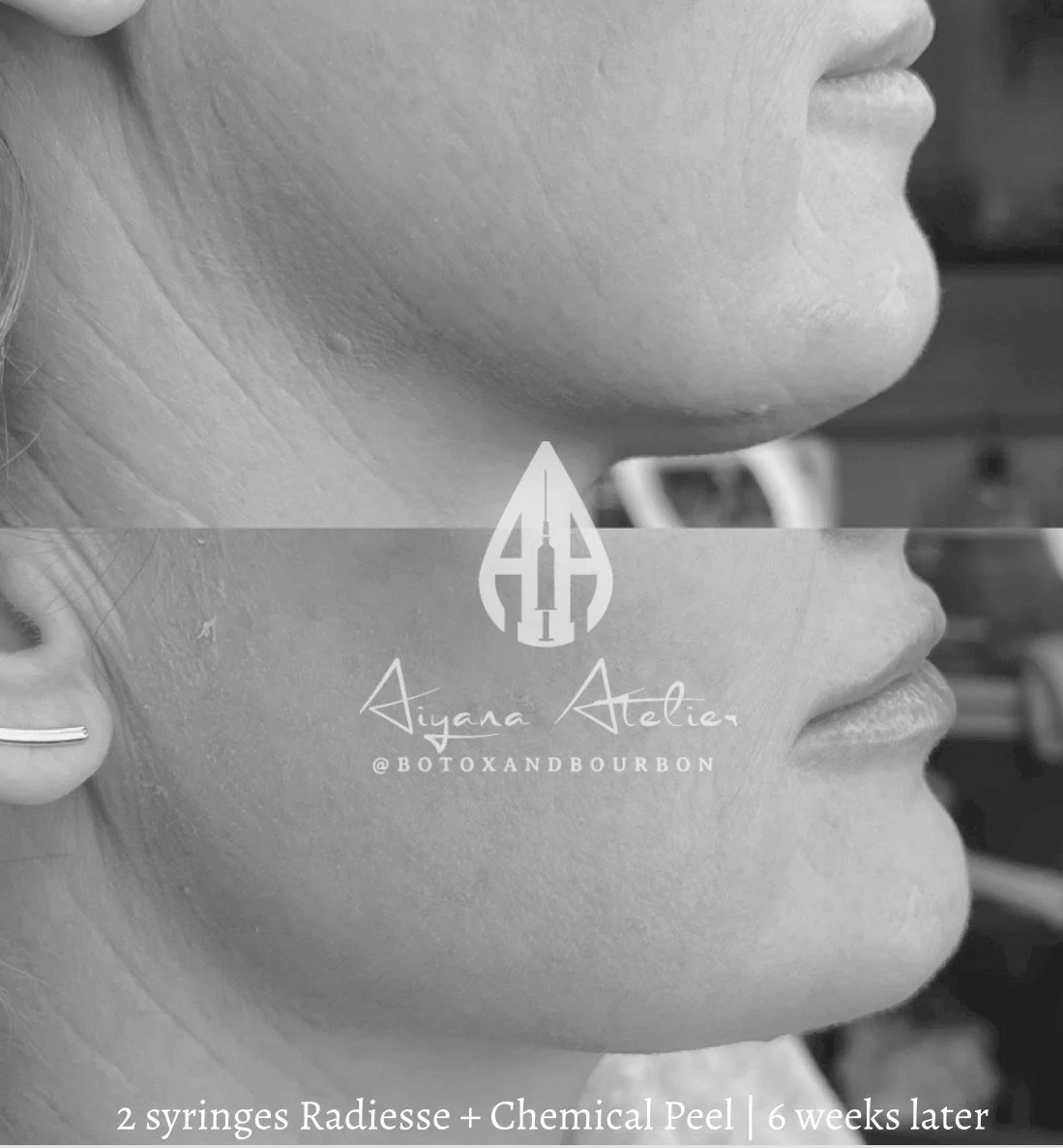 Side profile view of a woman's face before and after cosmetic treatment, including a 2-syringe Radiesse and chemical peel, with text indicating six weeks of progress.