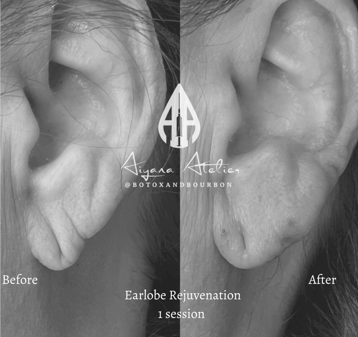 Black and white image showing before and after photos of a person's ear, highlighting the results of ear lobe rejuvenation treatment. The left side labeled 'Before' shows a sagging ear lobe, while the right side labeled 'After' shows a more firm and 