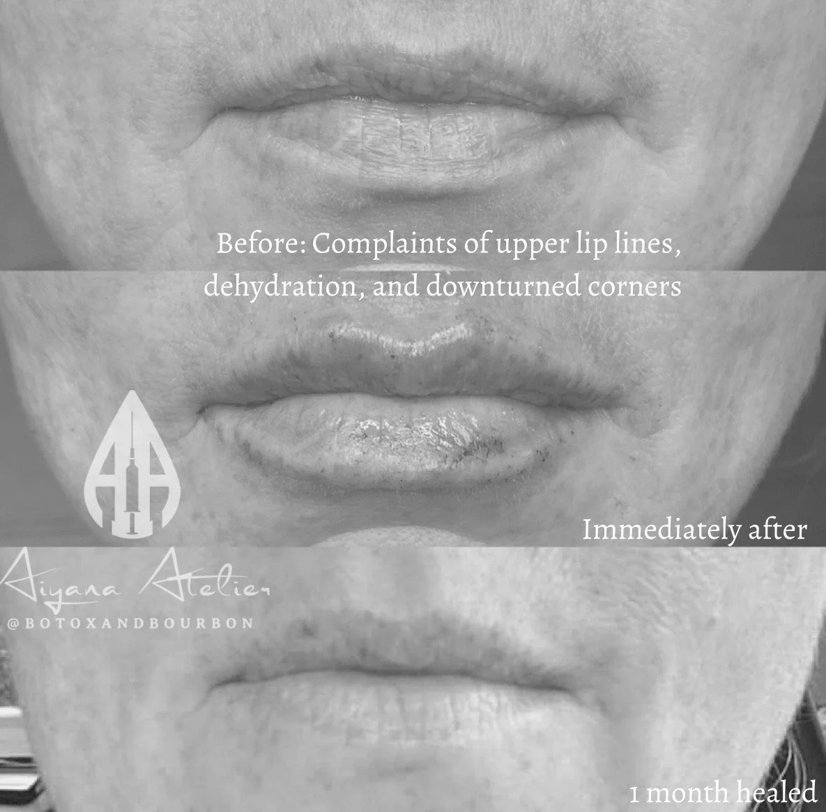 A side-by-side comparison of a person's lips before, immediately after, and one month after Botox treatment, showing improvements in upper lip lines, hydration, and corners.