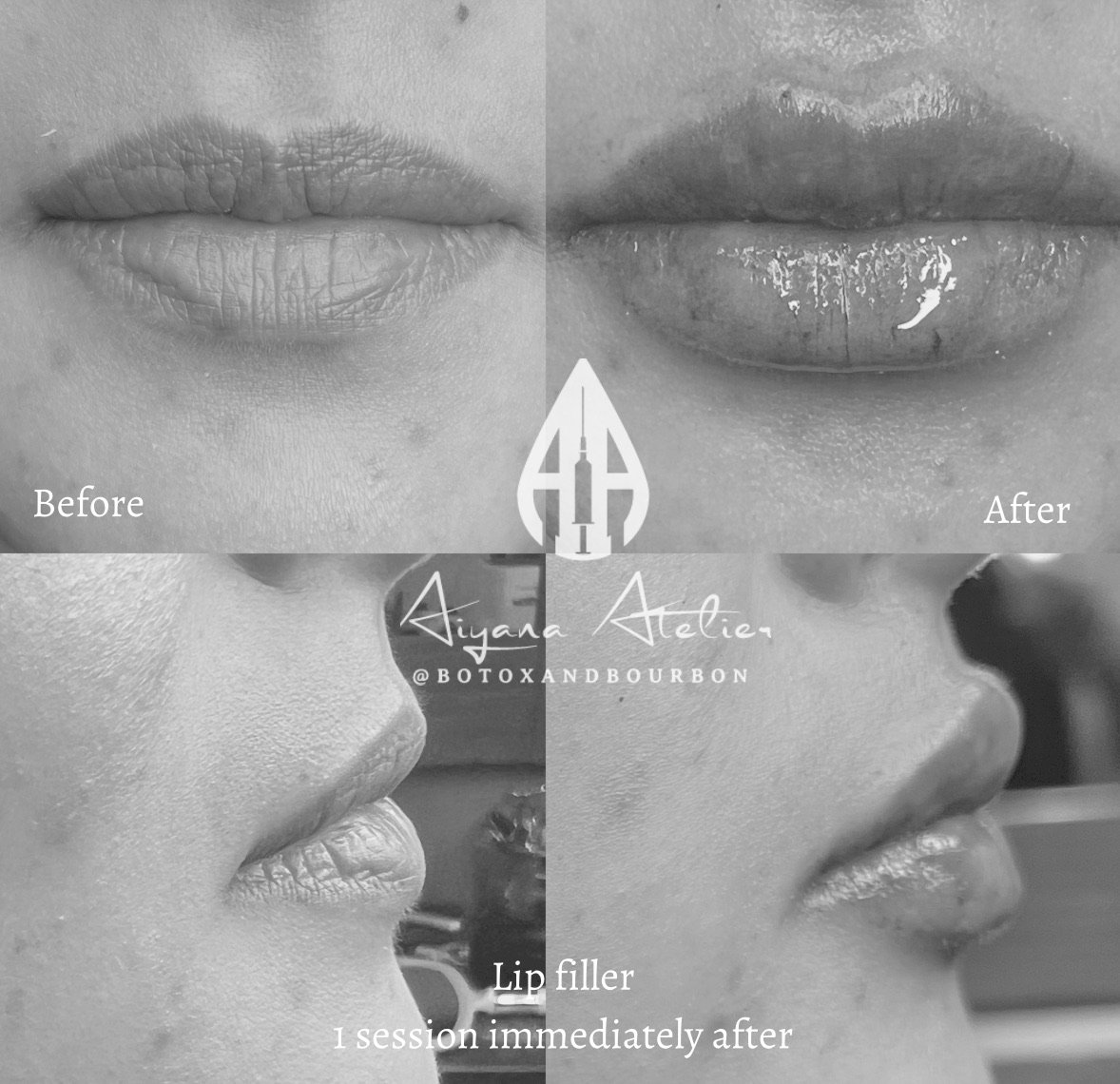 Black and white collage showing before and after results of lip filler treatment. Top left shows dry, wrinkled lips before, top right shows plumper, glossy lips after. Bottom left shows a side profile of lips before, bottom right shows fuller lips af