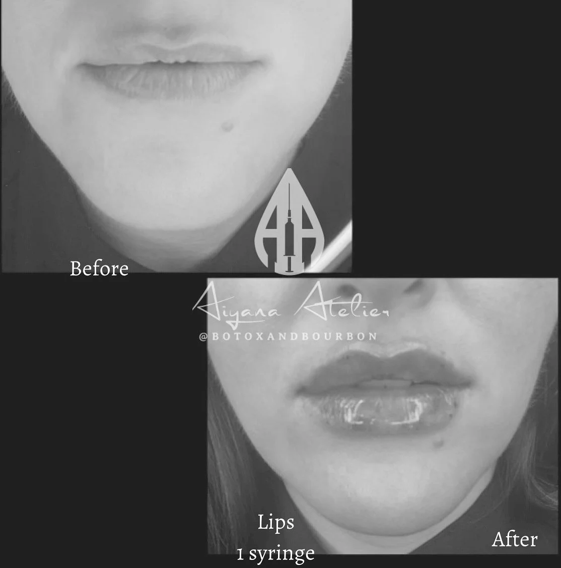 Comparison of lips before and after Botox treatment showing plumper lips after injection, with text indicating 'Before' and 'After' with '1 syringe' at the bottom.