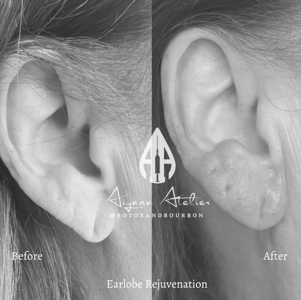 Black and white side-by-side comparison of a person's ear, showing before and after earlobe rejuvenation, credited to Aiyana Atelier, @botoandbourbon.