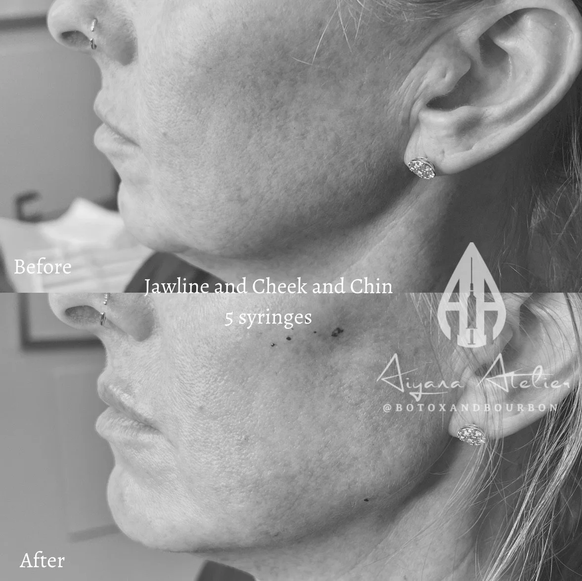 Side profile of a woman's face showing before and after facial treatment, highlighting improvement in skin texture with fewer blemishes and spots in the after image, with text indicating jawline, cheek, chin, 5 syringes, and a logo.