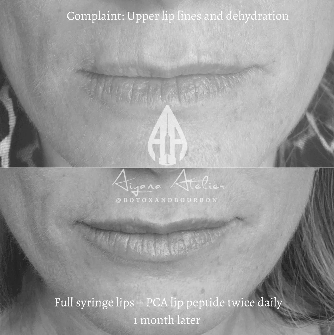 Comparison of lips before and after treatment showing reduction of upper lip lines and dehydration, with text overlay describing the treatment details.