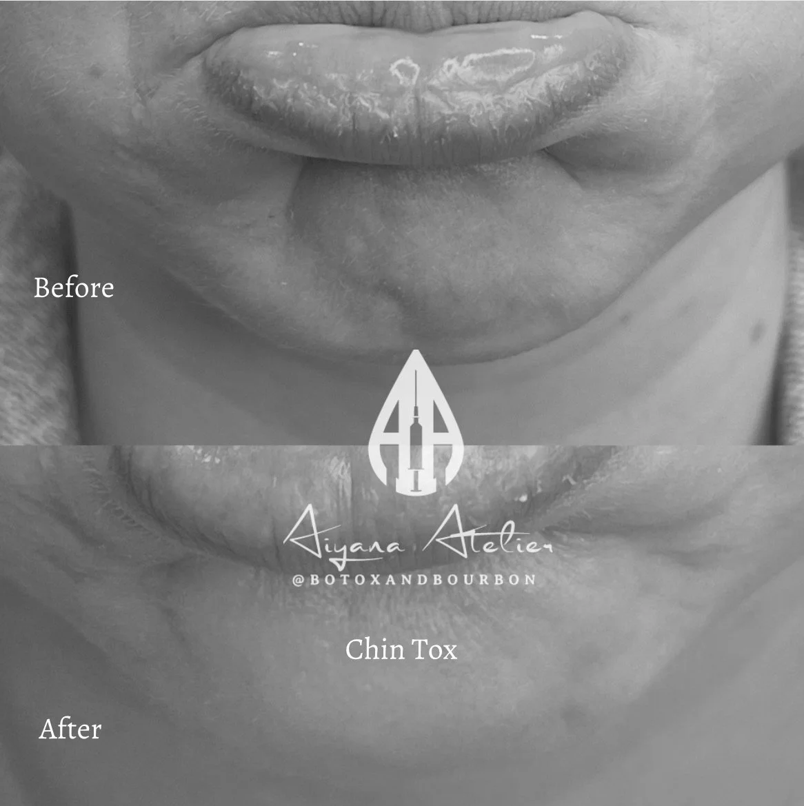 Black and white photo of lips before and after chin toxin (botox) treatment, with labels 'Before' and 'After' and a logo and text 'Aiyana Atelier @botoandbourbon' in the center.