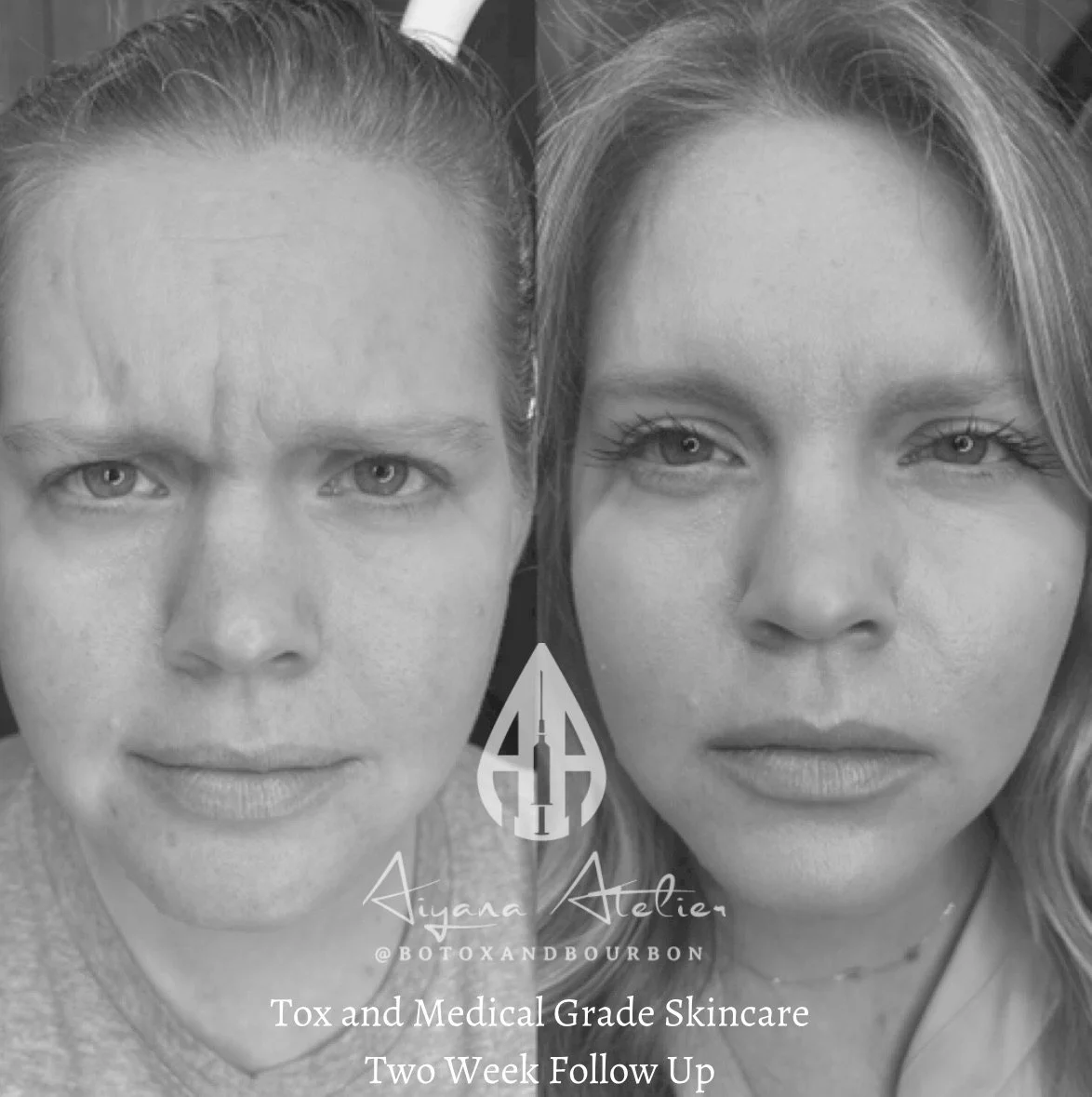 Black and white close-up of two women's faces, before and after toxin and medical grade skincare treatment, two-week follow-up.