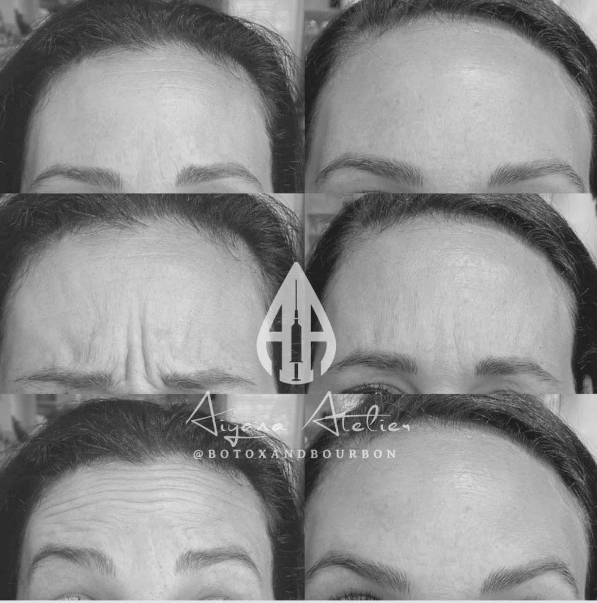 A collage showing before and after images of eyebrow and forehead treatments, illustrating wrinkles reduction and eyebrow enhancement with a logo and text overlay.