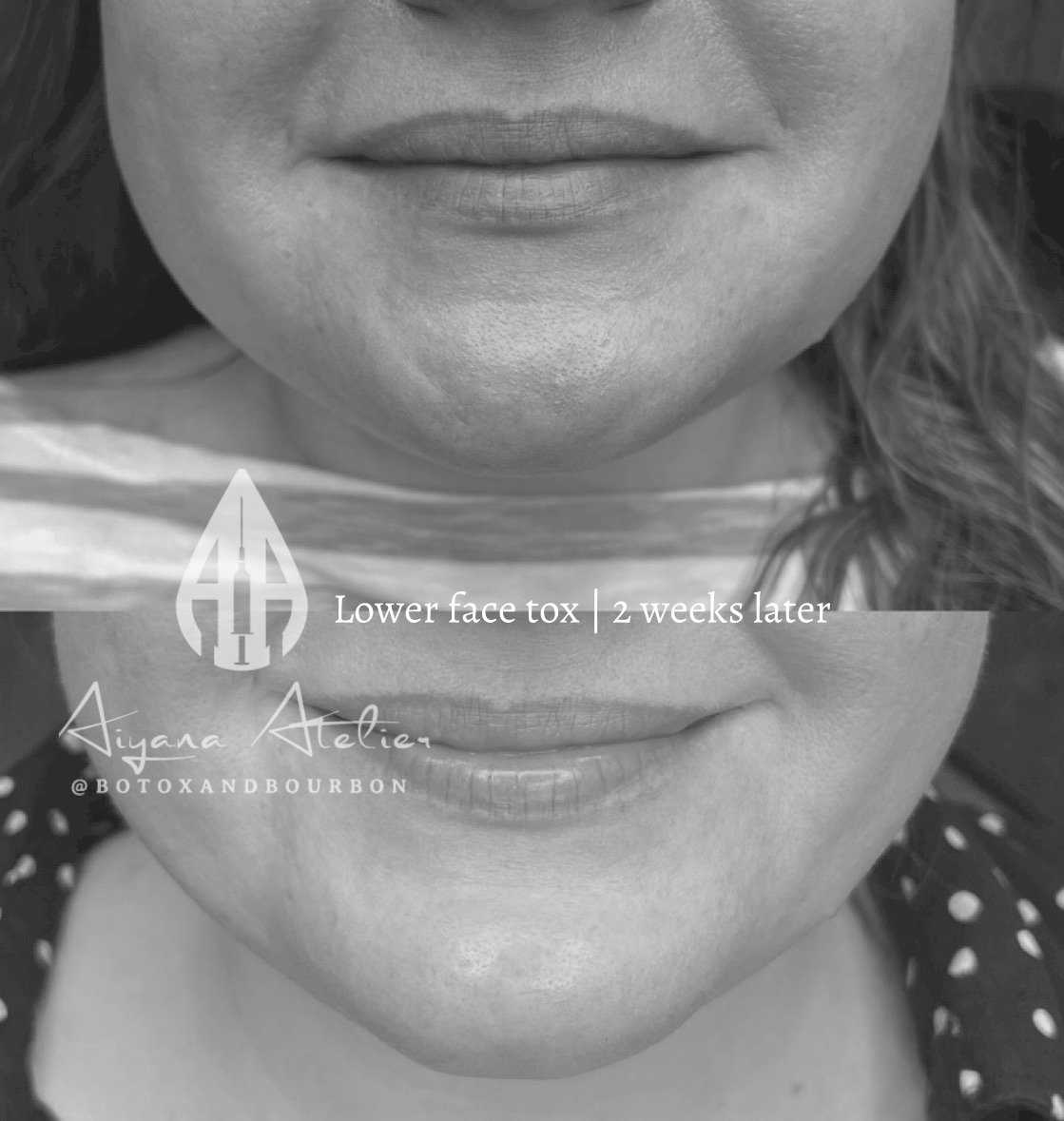 Comparison of lower face skin before and after two weeks of toxin treatment, showing smoother skin and reduced wrinkles.