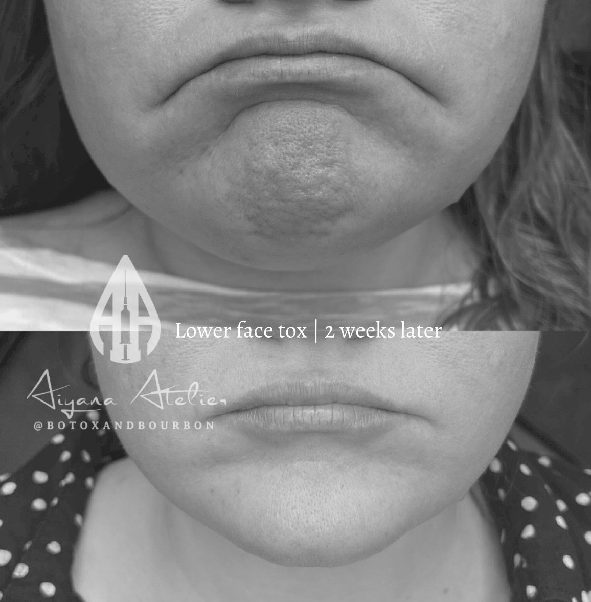 Before and after photos of a person's lower face showing reduction in skin texture two weeks after receiving botox treatment.