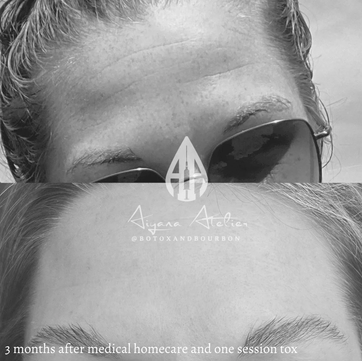 Close-up of a woman's face before and after Botox treatment, showing forehead and eyebrow area, with text indicating 3 months after medical homecare and one session toxin.