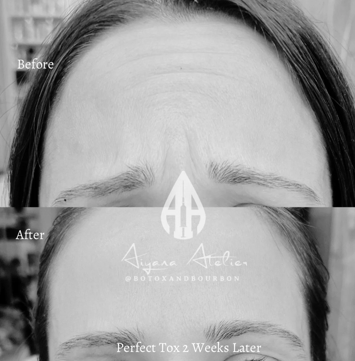 A black and white comparison of a woman's forehead before and after Botox treatment, showing reduced wrinkles two weeks after the procedure.