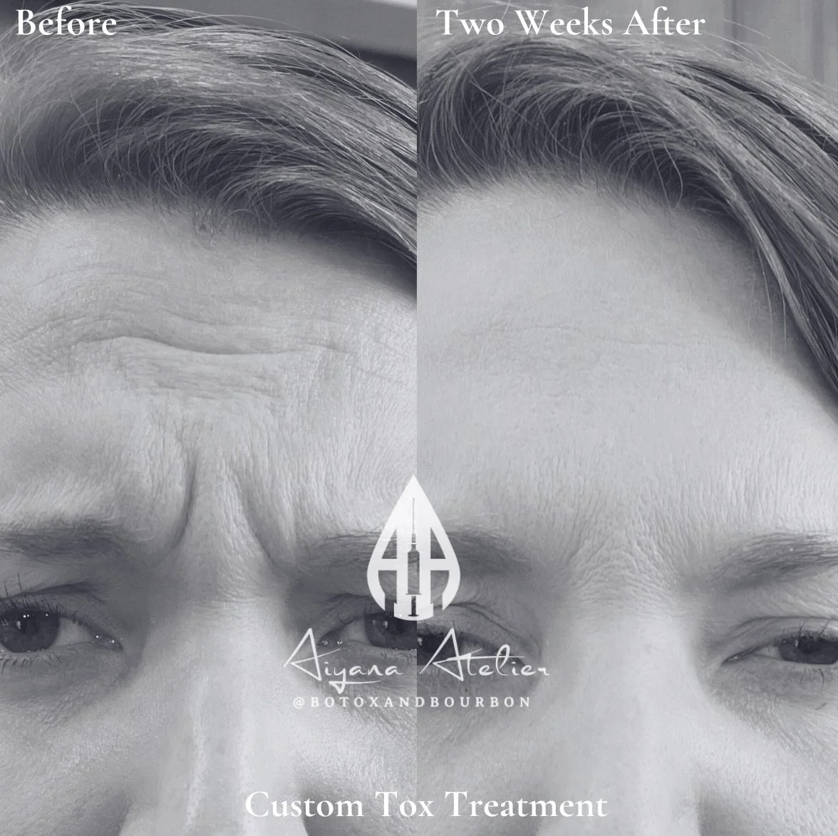 A side-by-side comparison of a person's forehead and eyebrows before and after a custom Botox treatment. The left side shows forehead wrinkles before treatment, and the right side shows a smoother appearance two weeks after treatment.