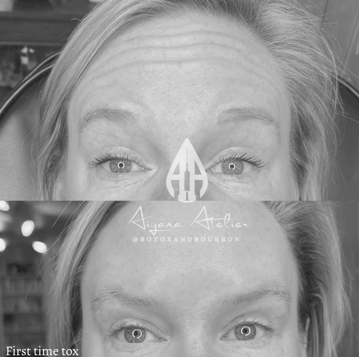 Comparison of a woman’s face before and after Botox treatment, showing smoother skin in the after photo, with branding and text related to a Botox specialist.