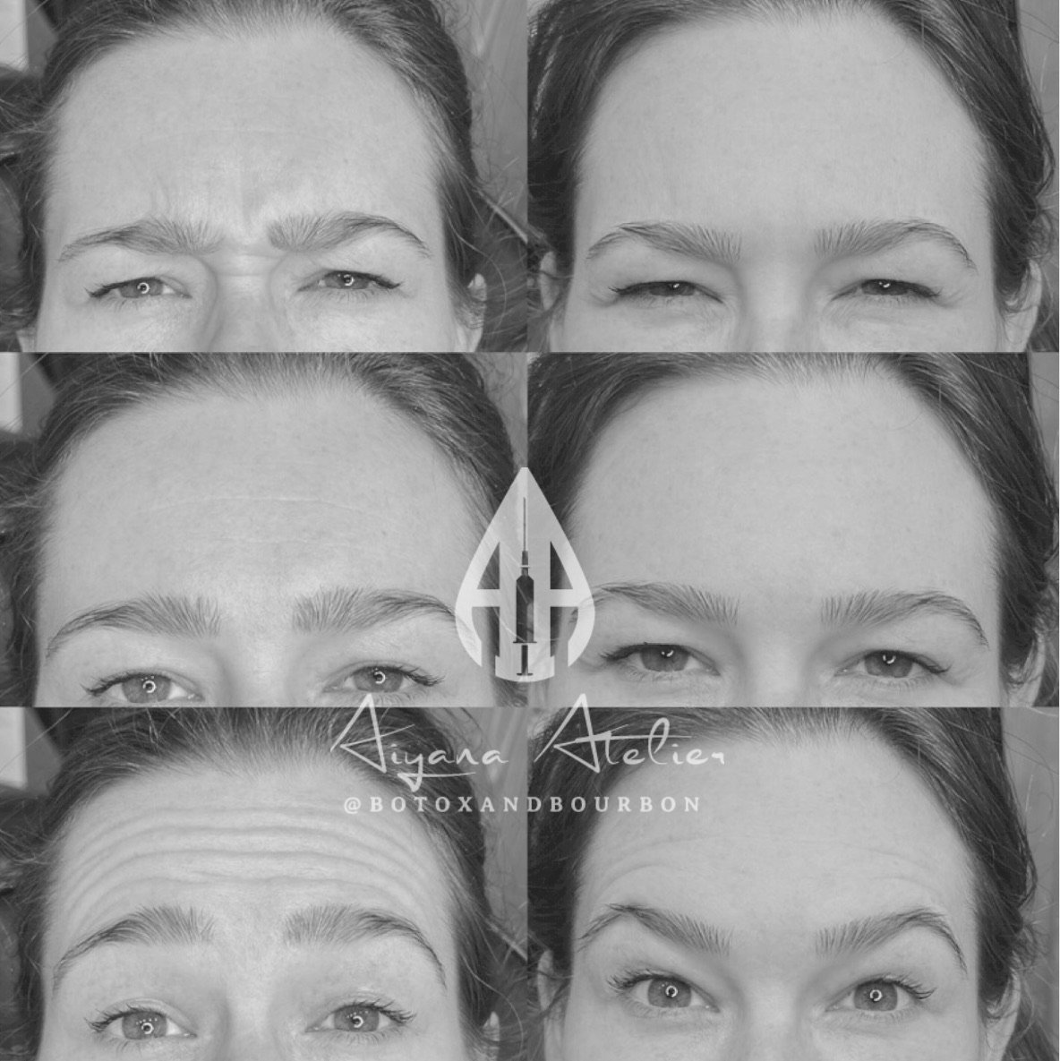 Before and after photos of a woman's face showing the effects of Botox treatment on forehead wrinkles, with a logo and the Instagram handle '@btoxandbourbon'.