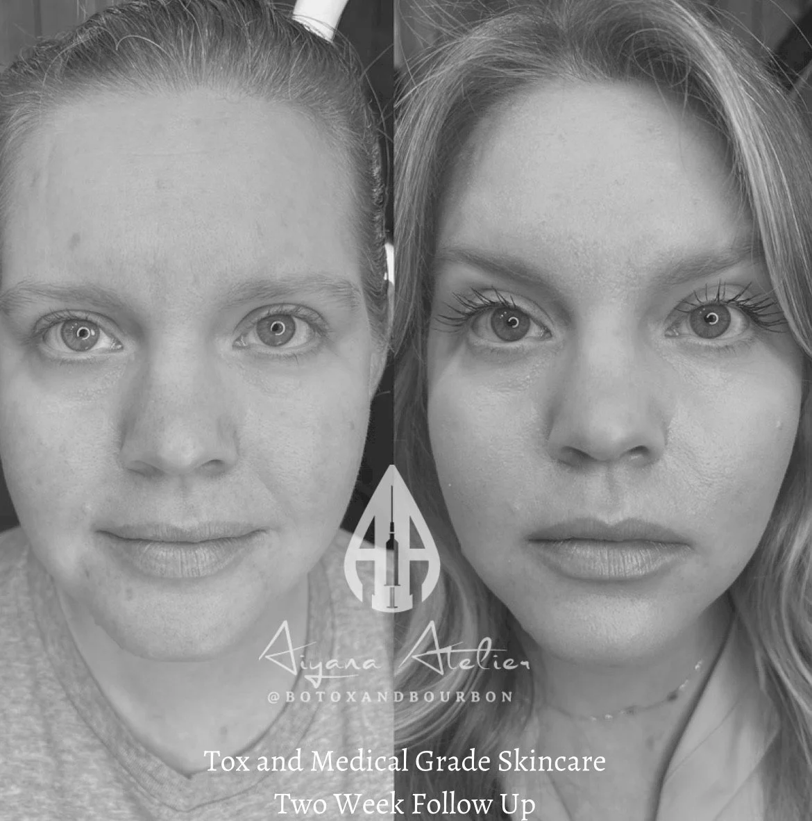 Side-by-side black and white photos of a woman before and after skincare treatment. The left photo shows her without makeup or enhancements, and the right photo shows her with makeup, mascara, and smoother skin. The image promotes Tox and Medical Gra