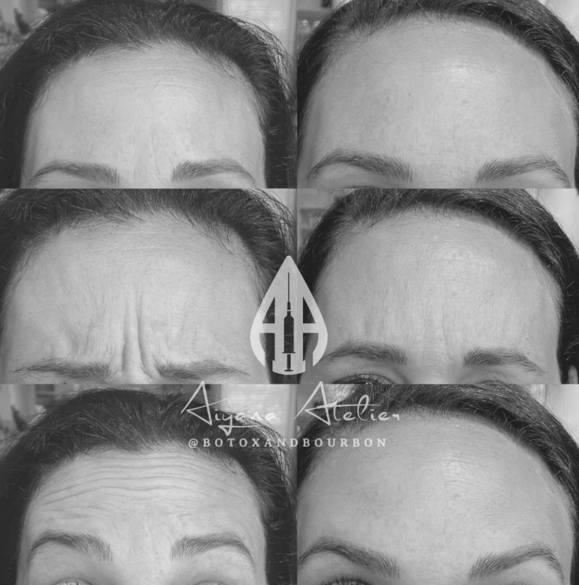A collage of black and white close-up photos showing forehead lines before and after Botox injections, with the middle featuring a syringe icon and the name 'Diana Allie' and social media handle '@BOTOXANDBOURBON'.