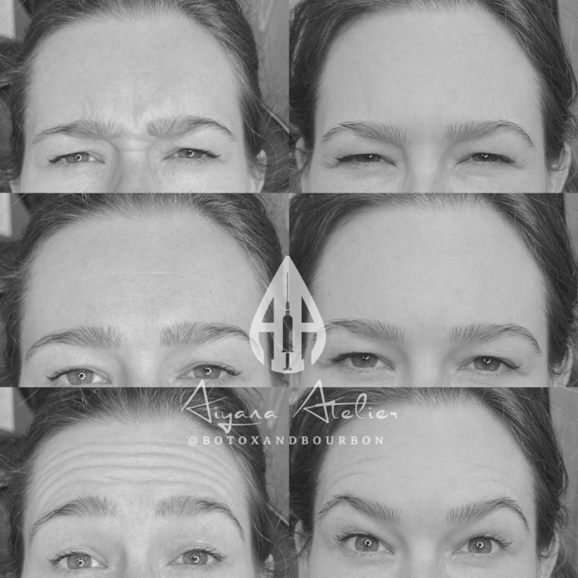 Compilation of black and white photos showing before-and-after results of Botox treatment on a woman's forehead and eyebrows.