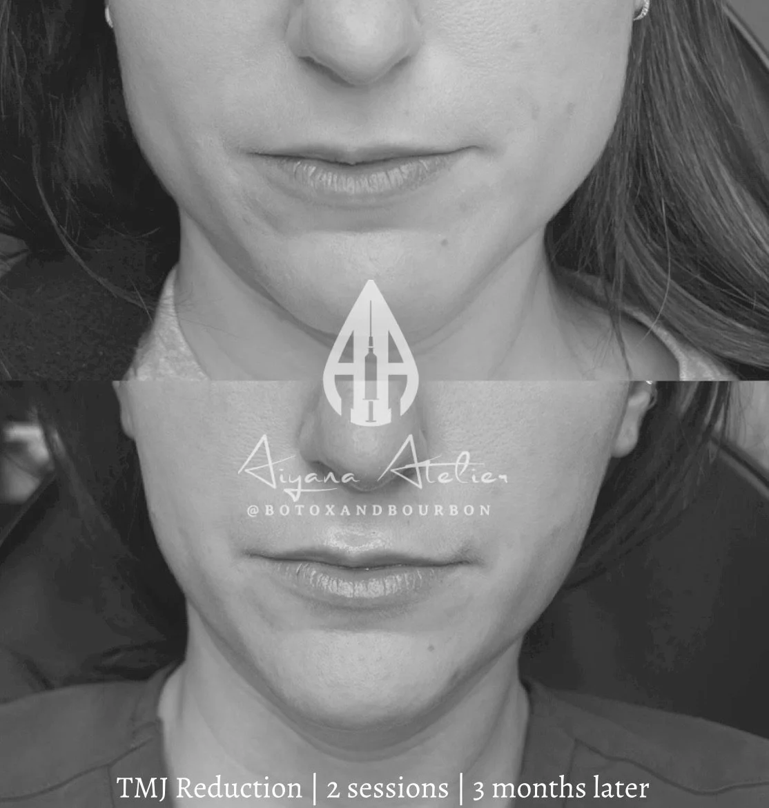 Before and after comparison of a woman's face showing TMJ reduction after two botox sessions over three months, black and white photos with text overlay.