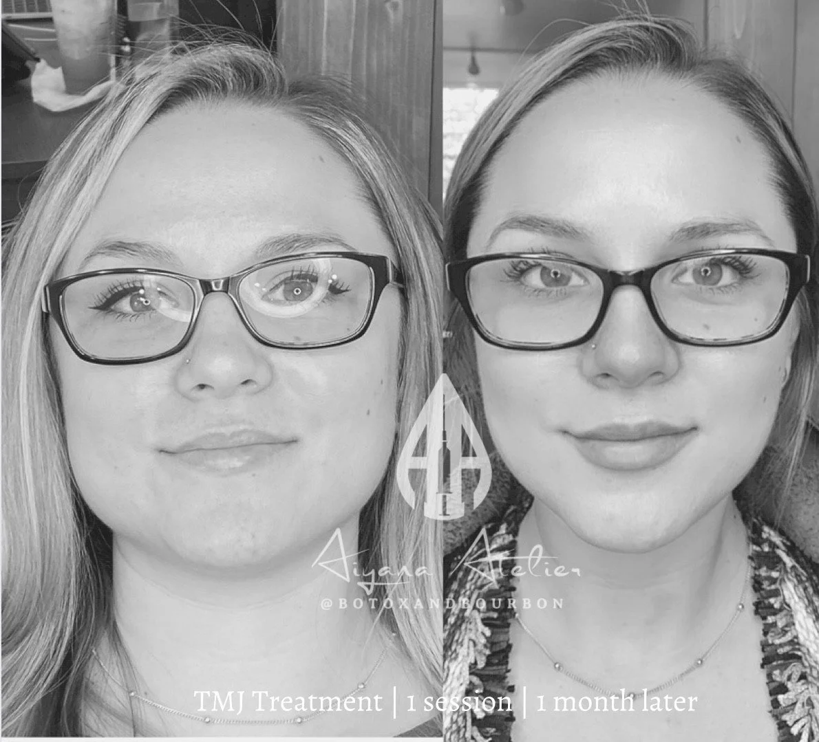 Black-and-white side-by-side photos of a woman before and after a TMJ treatment, showing improvement in jaw alignment and facial symmetry.