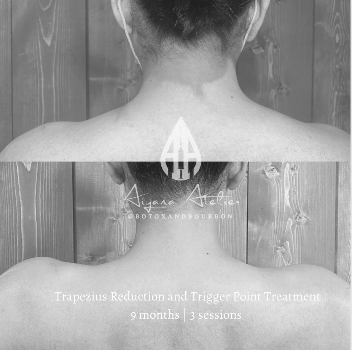 A black and white photo showing the back of a person's neck and shoulders. The top part of the image shows the person's hair and ears, with the lower part including the neck and upper back. Overlaid text indicates a treatment called Trapezius Reducti