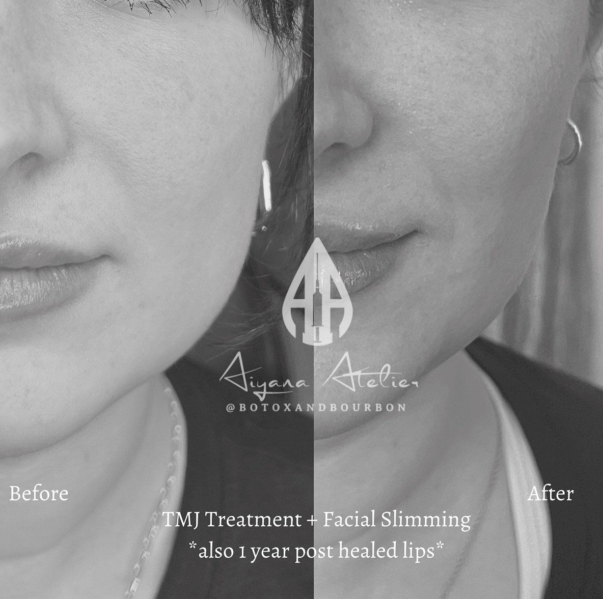Split black and white photo showing a woman's face before and after TMJ treatment and facial slimming, with the before on the left and after on the right. Text on the image reads 'Aiyana Atelier @botoandbourbon' and 'TMJ Treatment + Facial Slimming *