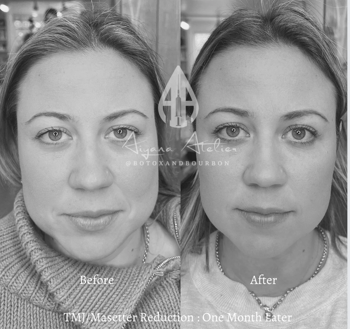 Comparison photo showing a woman's face before and after Botox treatment, with visible reduction in facial wrinkles. The left side labeled 'Before' shows more wrinkles, and the right side labeled 'After' shows smoother skin. The woman has light-color