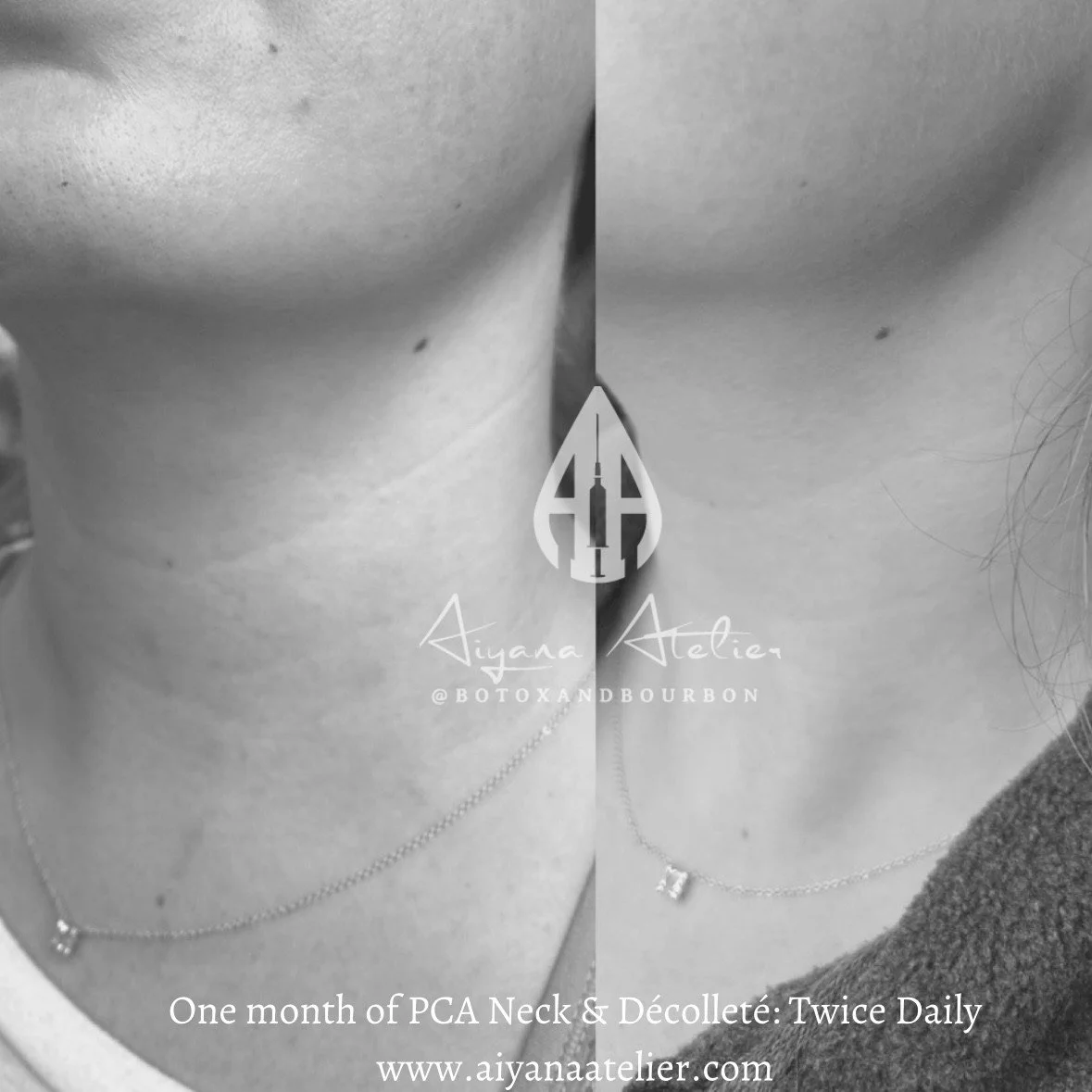 Comparison of neck area before and after one month of PCA Neck & Décolleté treatment, showing improvements; black and white photo with text overlay and a logo.