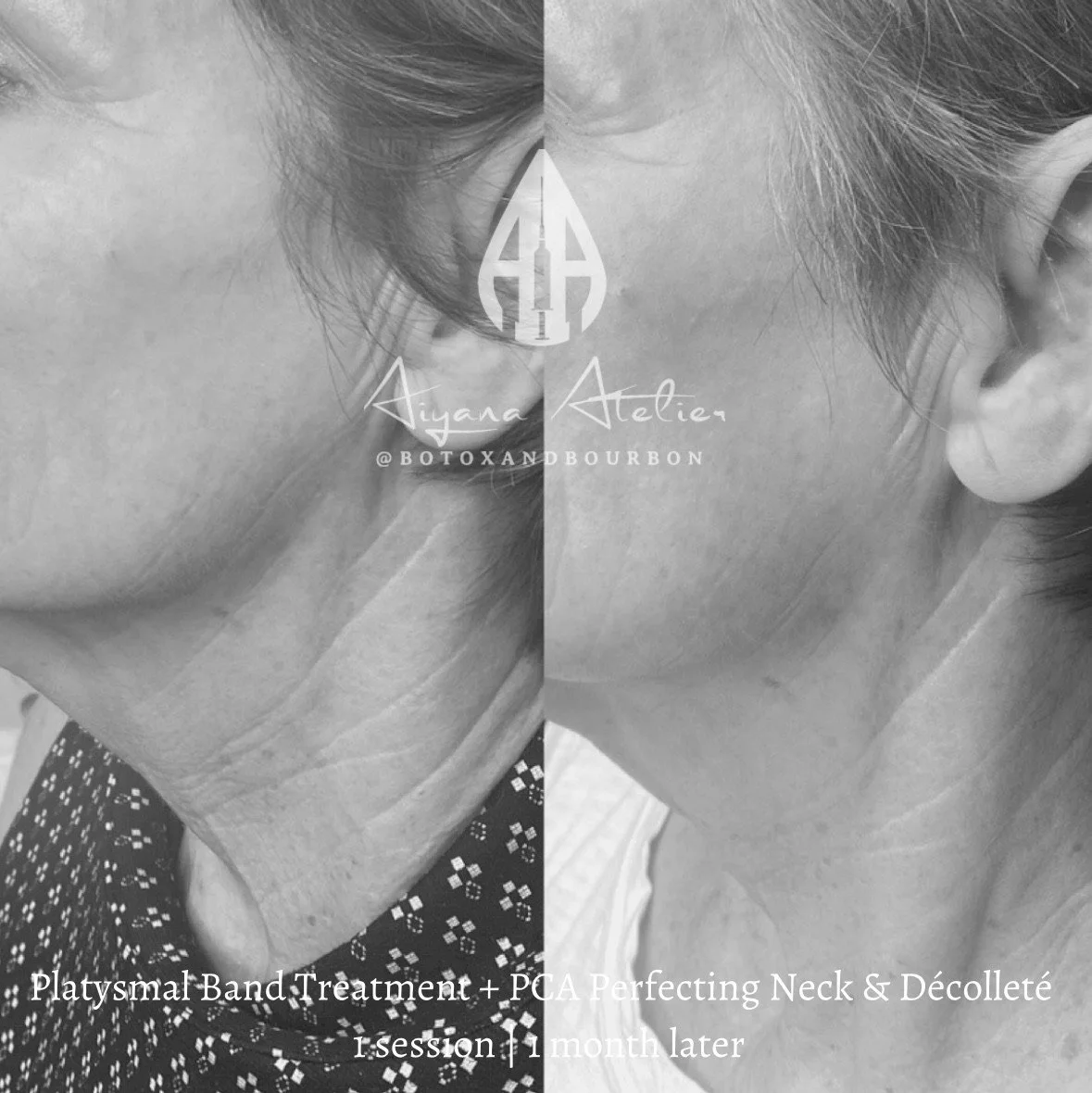 Black and white side-by-side comparison of a woman's neck and jawline before and after treatment, showing improved skin appearance. Text overlay indicates the treatment is PlatySmal Band Treatment plus PCA Perfecting Neck and Décolleté, with the sess