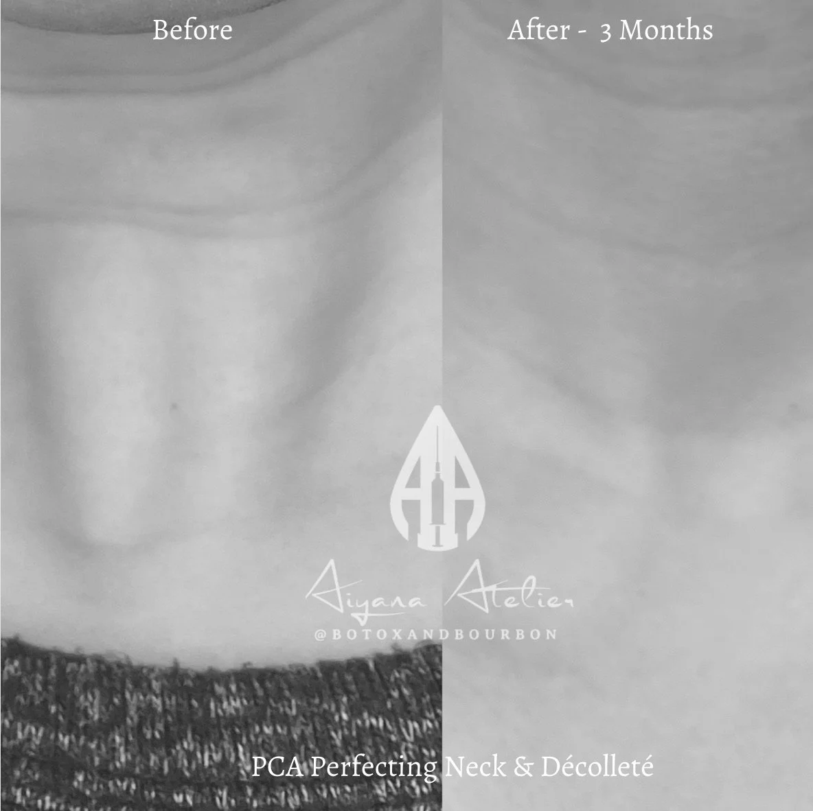 A side-by-side comparison of an untreated and a three-month treated neck area, showing reduction in skin wrinkles and lines. The image promotes PCA Perfecting Neck & Décolleté by Jiyana Atelier, with a logo and Instagram handle @botoxandbourbon.