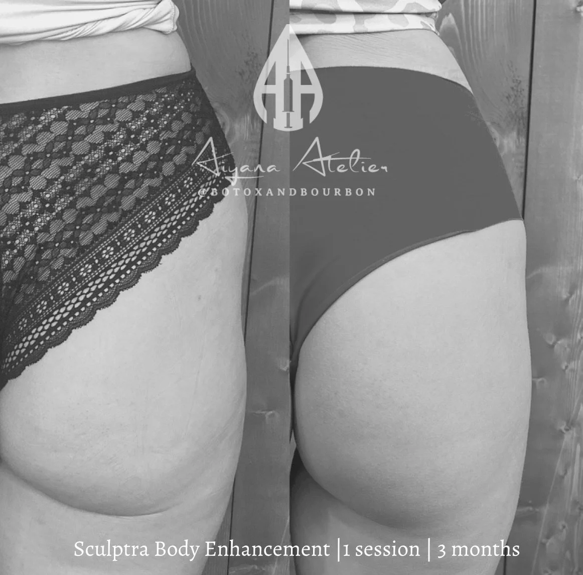 Black and white photo of two women's lower bodies, one wearing lace underwear and the other in plain underwear, with a reflection in a mirror. Text overlay indicates "Sculptra Body Enhancement, 1 session, 3 months."