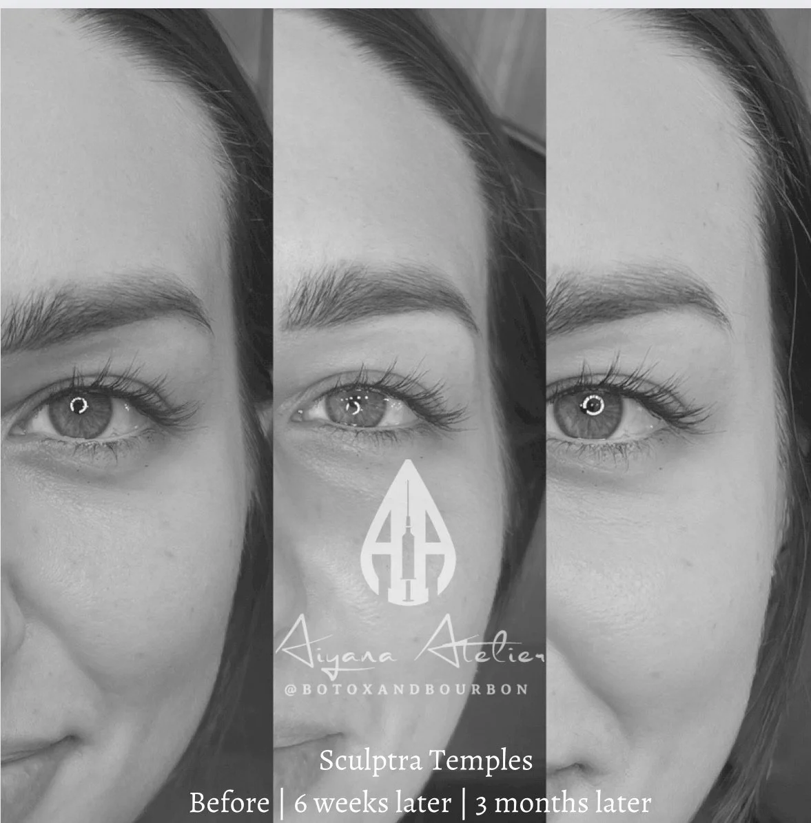 Timeline of a woman's face showing the results of Sculptra temples treatment over three time points: before, six weeks later, and three months later, with text indicating the progression.