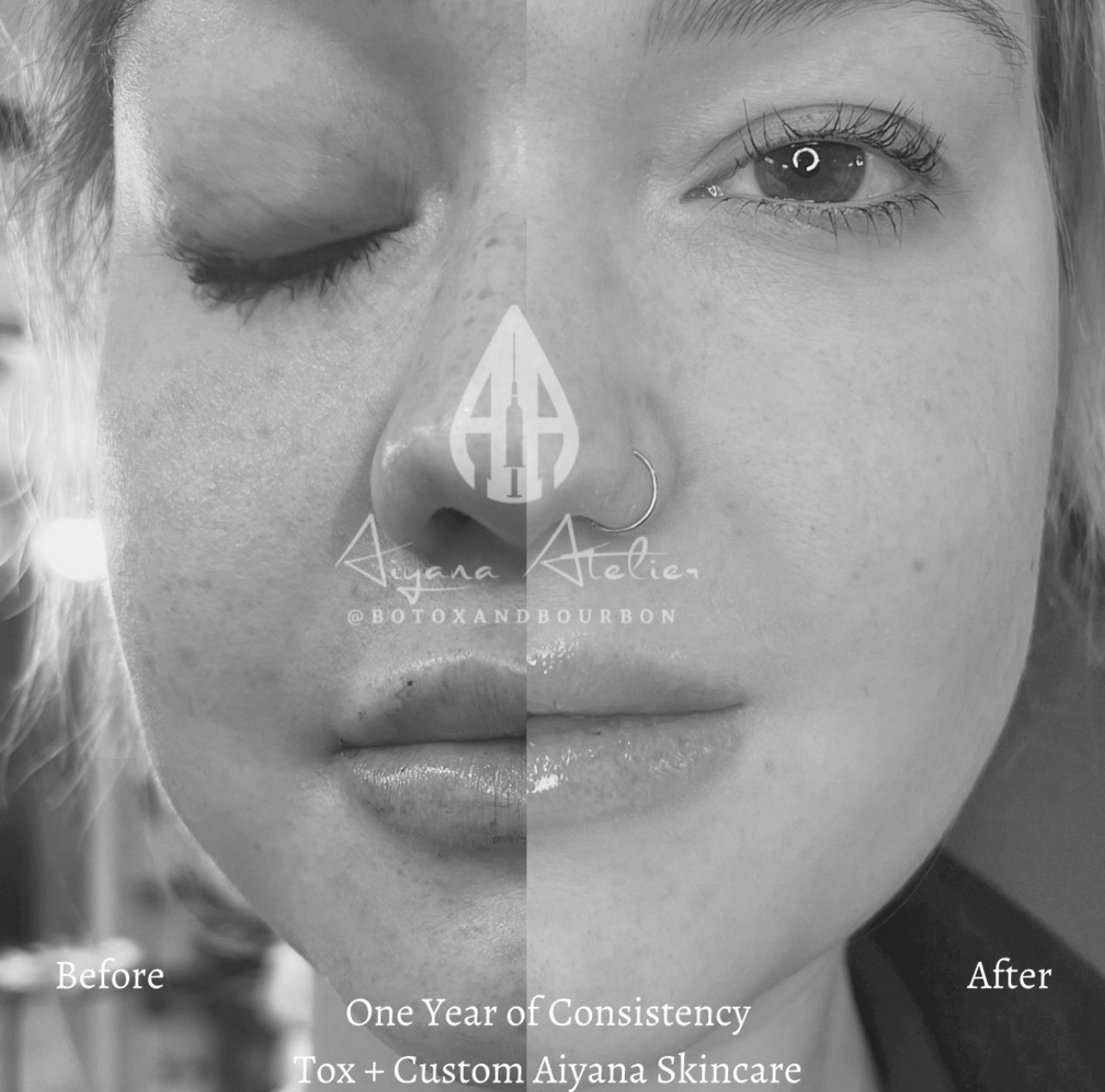 Close-up of a woman's face showing a side-by-side comparison of her skin before and after one year of consistent toxin and custom Aiyana skincare, with details on her eye, nose, and lips.
