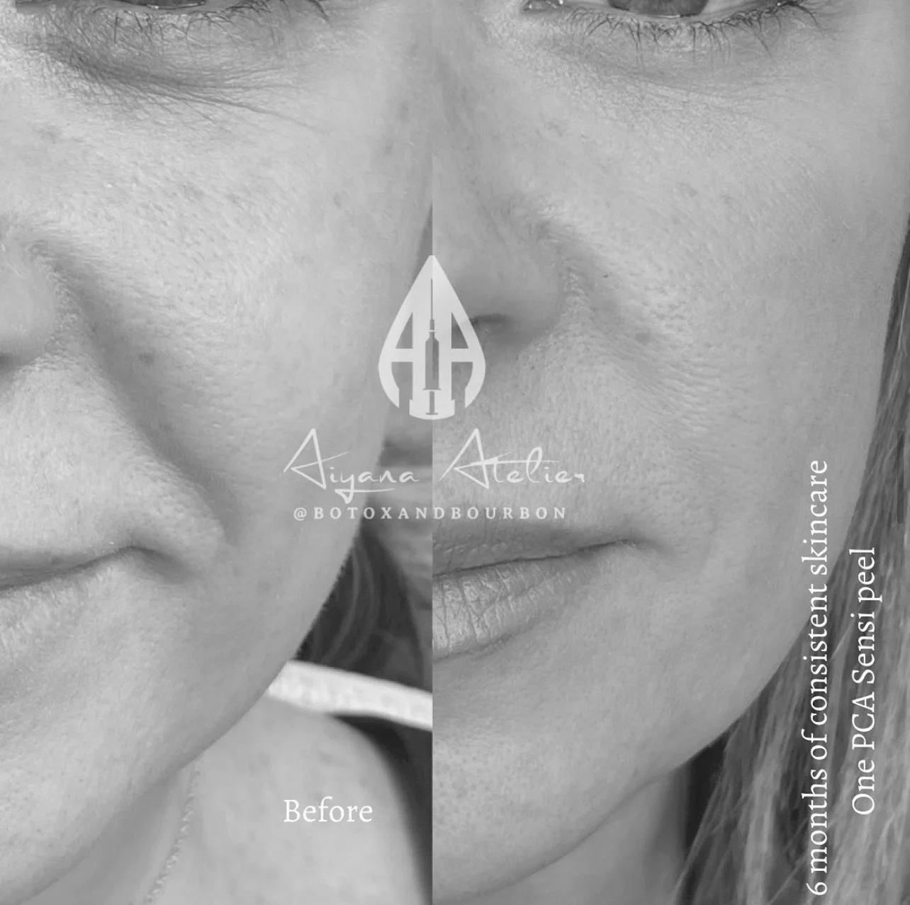 A close-up of a woman's nose and lips, showing a side-by-side comparison of her skin before and after a skincare treatment. The left side shows her skin before, and the right side shows her skin after six months of consistent skincare. The image incl
