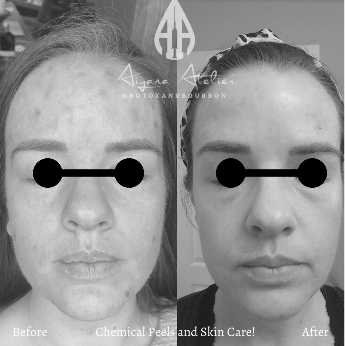 Side-by-side comparison of woman's face before and after facial treatment, with the text 'Before' under the left image and 'After' under the right image. The left shows skin with chemical peel effects, and the right shows improved skin condition. Ove