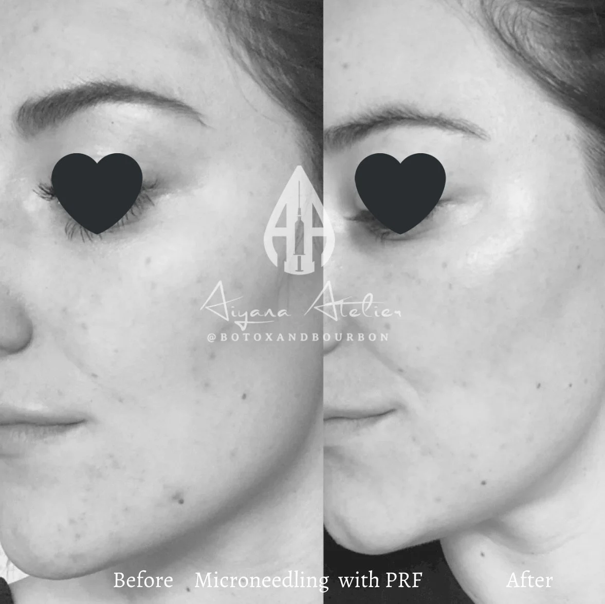 Side-by-side black and white photos showing a woman's face before and after microneedling with PRF, focusing on improvements in skin texture and clarity.