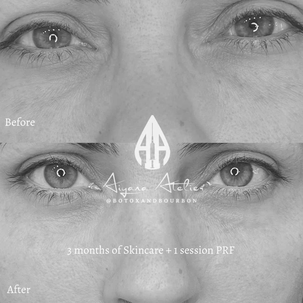 Close-up black-and-white photo of a person's face showing the eye area, with a 'Before' label on top and an 'After' label on bottom. Text on the image describes a skincare and PRF session for improved skin appearance.