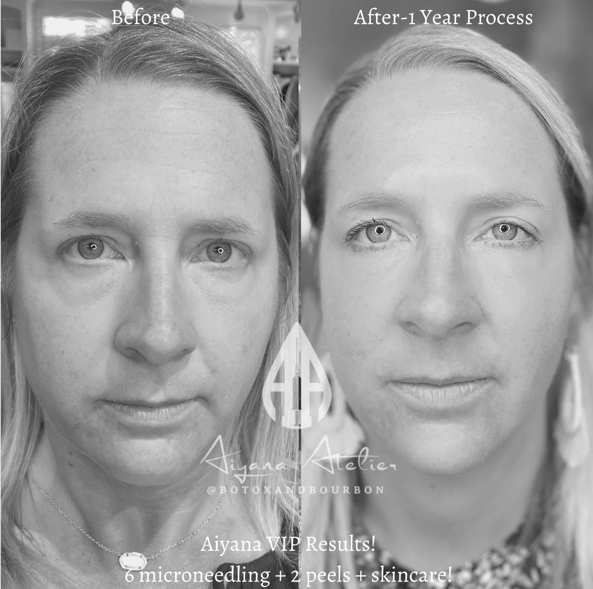 Side-by-side comparison of a woman's face before and after one year of skincare treatments, including microneedling, peels, and skincare products. The 'before' image shows signs of aging with more wrinkles and uneven skin texture; the 'after' image s