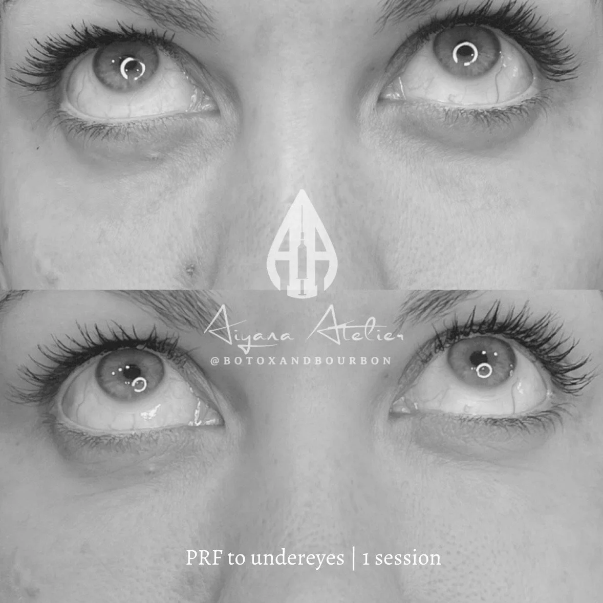 Black and white promotional image showing a close-up of a woman's eyes before and after PRF treatment to under-eyes, with text overlay of the artist's name Aiyana Atelier and social media handle @botoandbourbon, and a note indicating one session of P