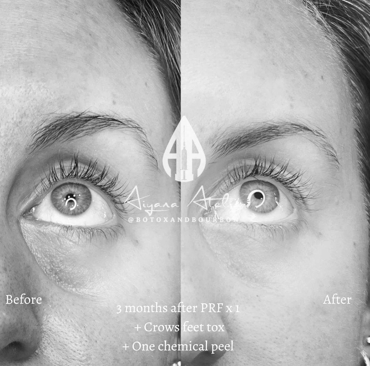 Close-up black and white photo comparing the left and right sides of a woman's face, showing the effects of cosmetic treatments. The left side is labeled "Before," and the right side is labeled "After." The image indicates a 3-month period after PRF 