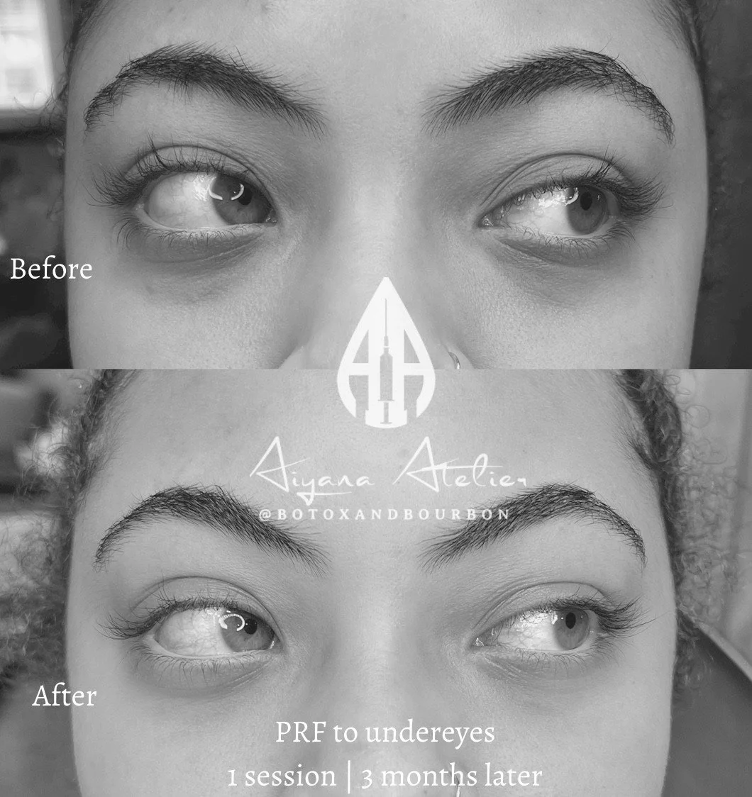 Comparison of eyebrows before and after PRF treatment to under-eyes, showing improved fullness and shape, with text indicating 'Before' at the top and 'After' with details about PRF treatment at the bottom.