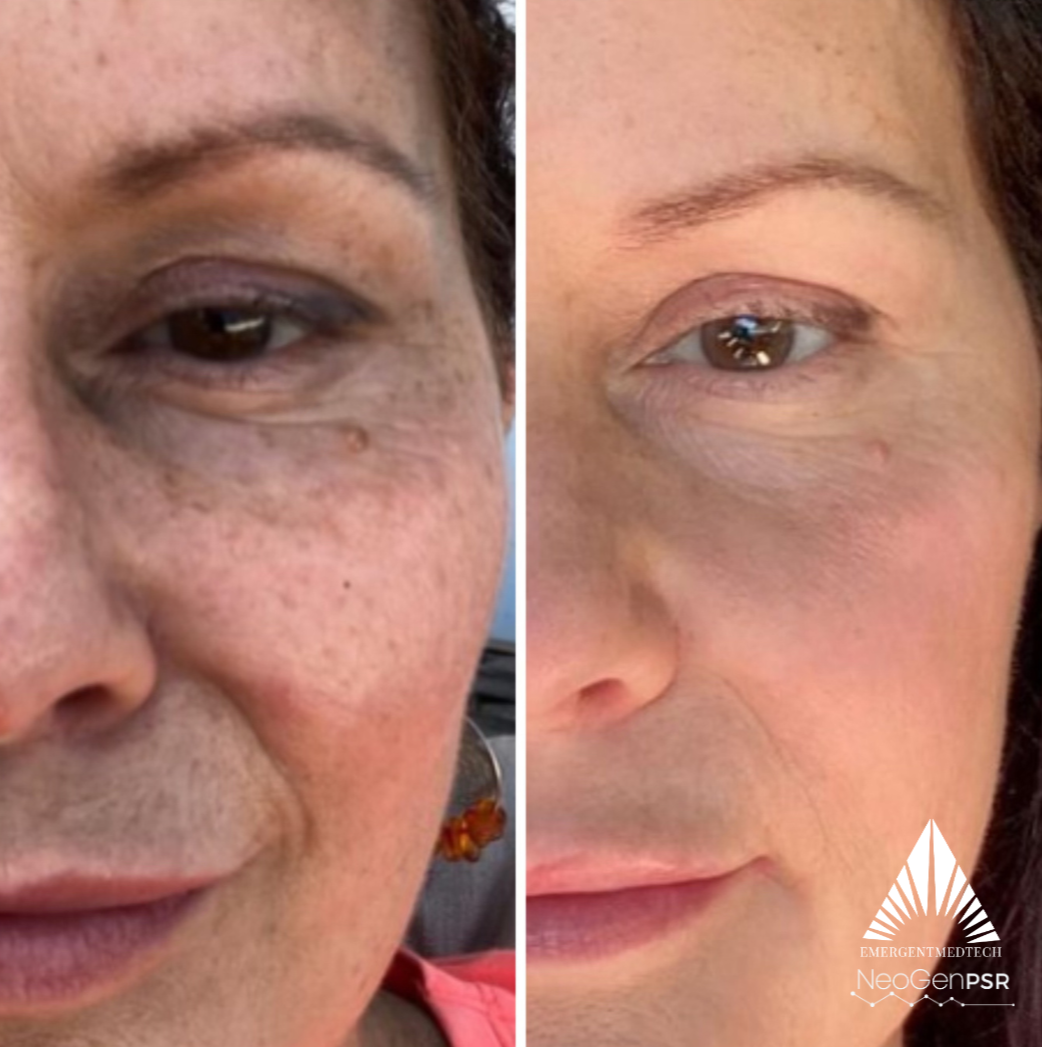 Side-by-side comparison photo showing a person's face before and after skincare treatment, with improvements in skin texture, tone, and reduction of dark spots.