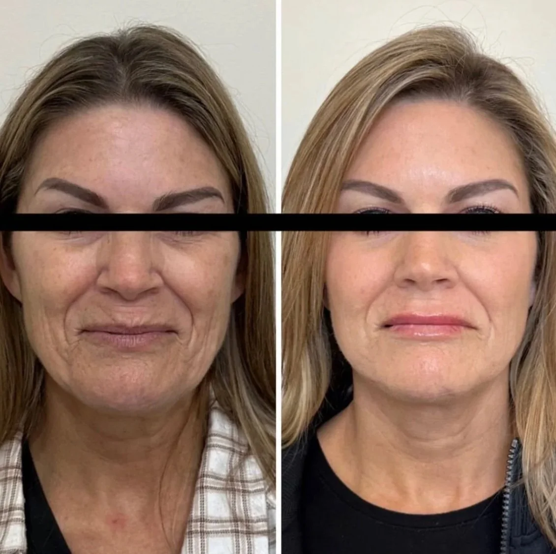 Side-by-side comparison of a woman's face before and after a cosmetic treatment, showing improvements in skin texture and appearance.
