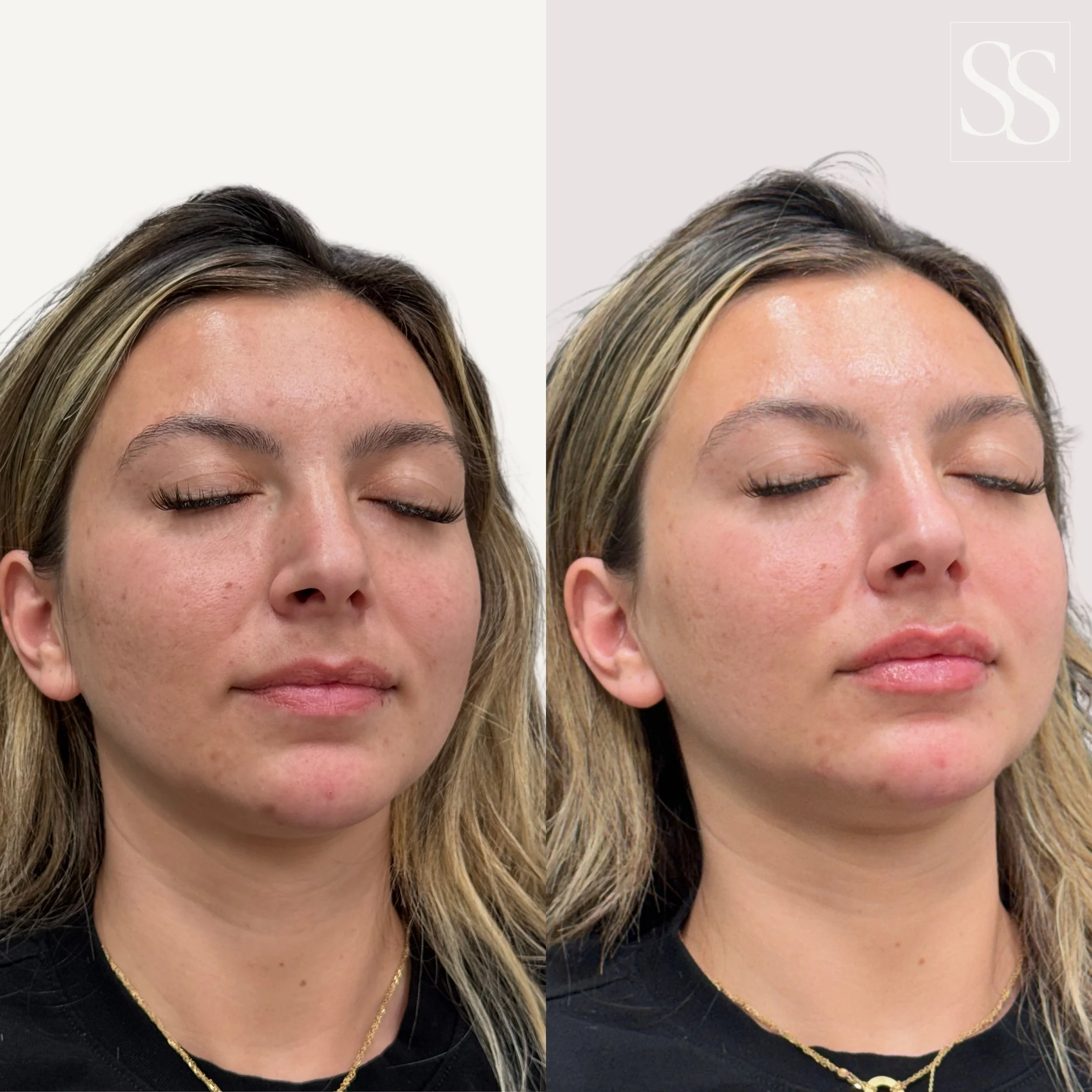 Sometimes the smallest changes create the biggest impact.

A touch of lip enhancement + subtle chin balancing created softer proportions, improved facial harmony, and a beautifully refreshed profile, all while keeping her uniquely her.

Natural. Bala