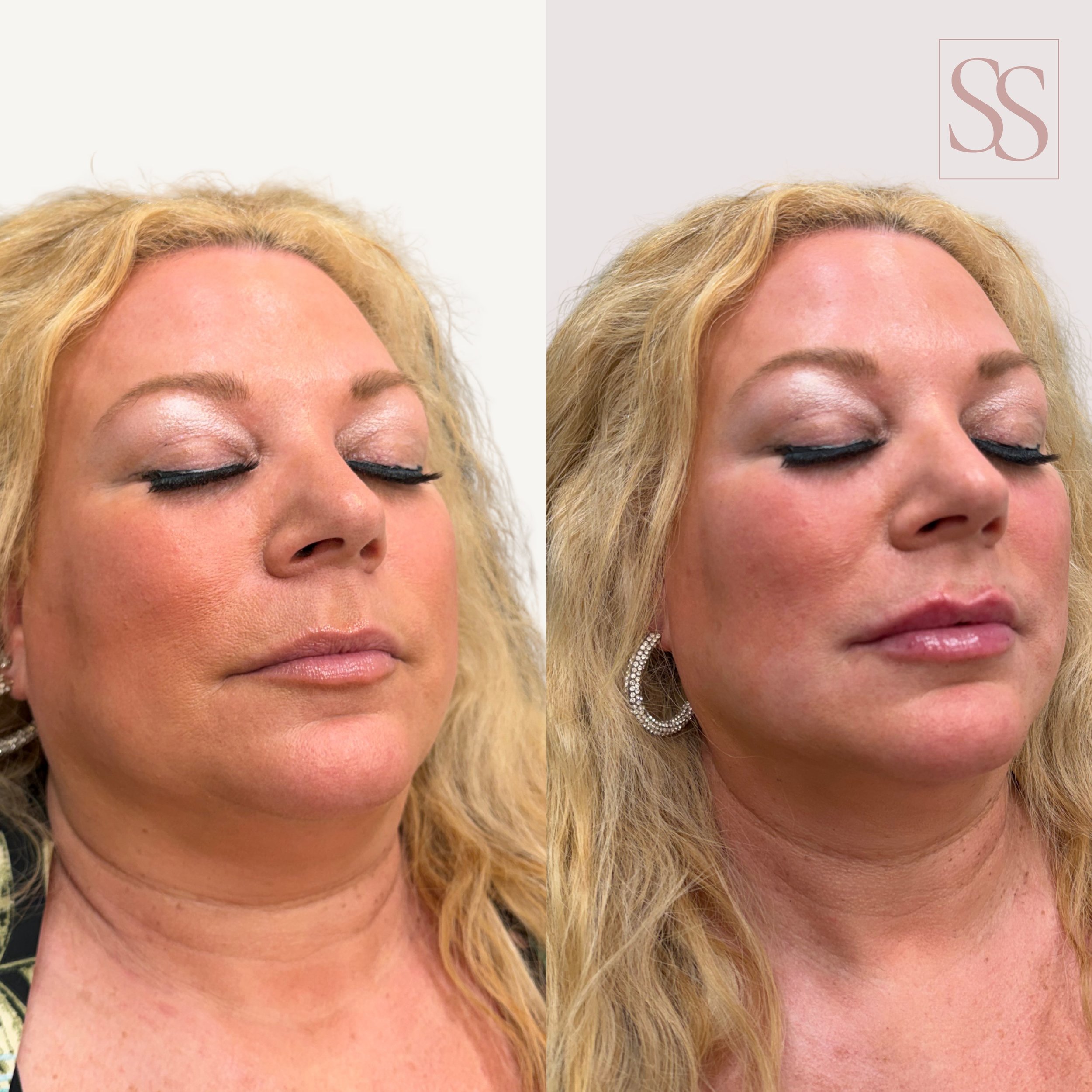 A little volume. A little definition. A whole lot of pretty! 💋

This gorgeous client came in ready to restore a little volume, redefine her shape and bring her lips back to life! 

Book your filler appointment. 🔗 in bio! 

#lipfillers #skinsocietym